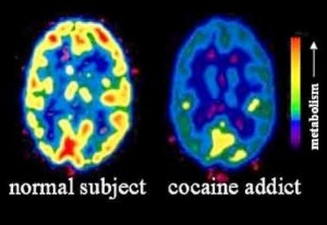 neuroimaging cocaina